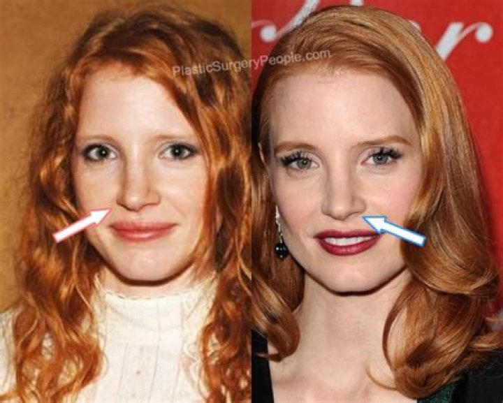 
Jessica Chastain | Nose Surgery 